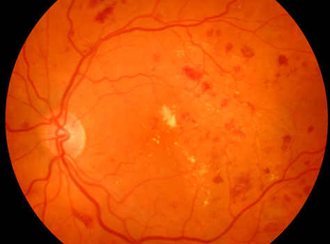 Diabetic Ocular Health Assessment